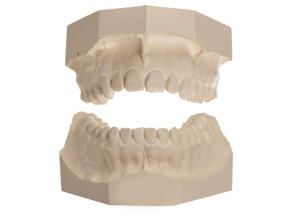 Dental Stone Model
